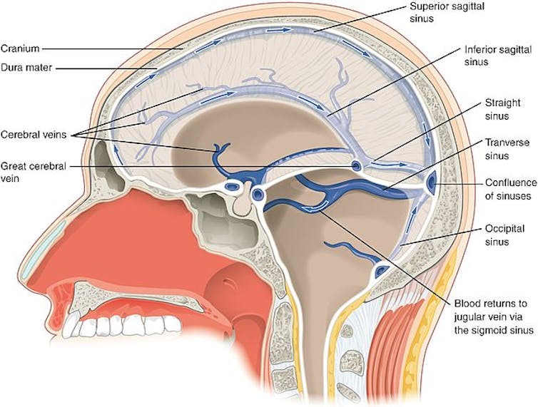 A diagram showing the sinuses that drain blood out of the brain