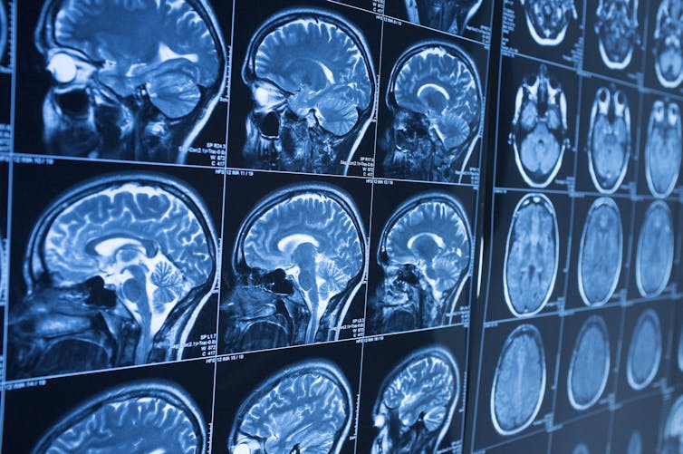 Brain MRI images showing multiple views