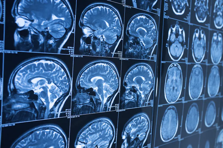 Brain MRI images showing multiple views