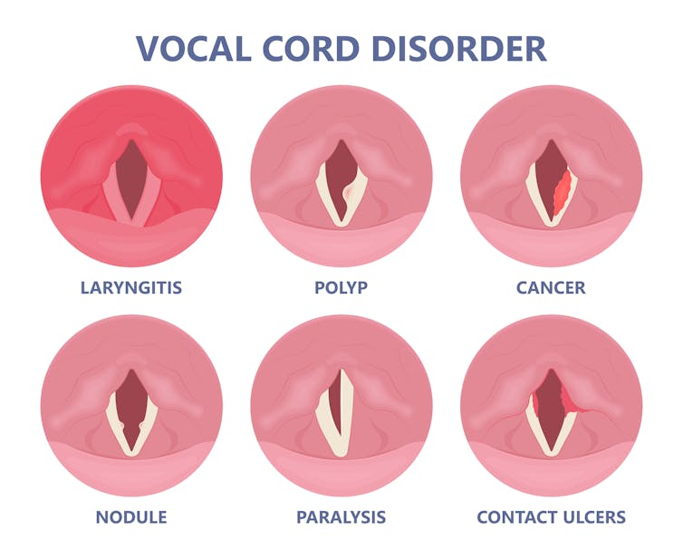 How long do you lose your voice for?