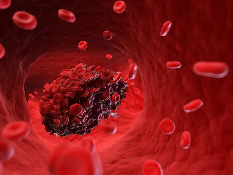 A blood clot inside a vein