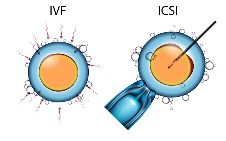 IVF versus ICSI