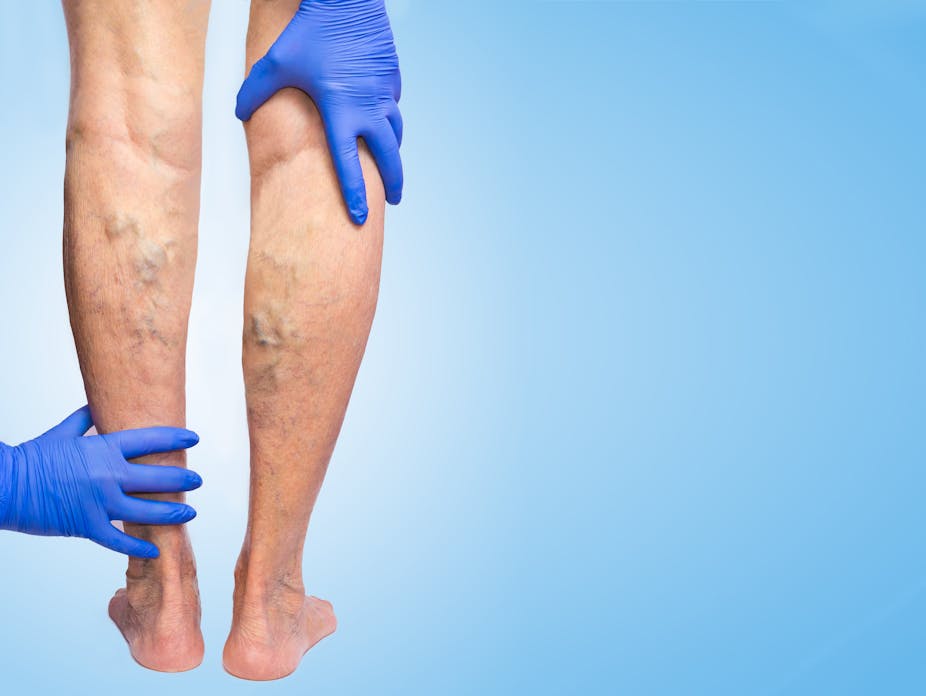 A doctor examines a person's varicose veins in their legs.