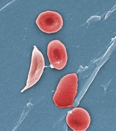 Four round red blood cells and one sickle-shaped red blood cell