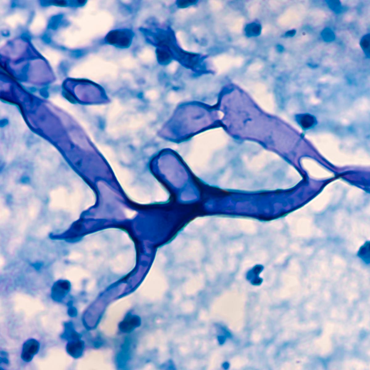 What Is Mucormycosis The Fungal Infection Affecting Covid Patients In India What Is Mucormycosis The Fungal Infection Affecting Covid Patients In India