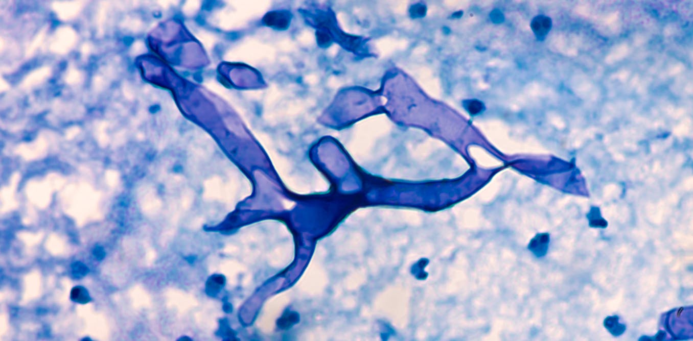 What Is Mucormycosis The Fungal Infection Affecting Covid Patients In India What Is Mucormycosis The Fungal Infection Affecting Covid Patients In India