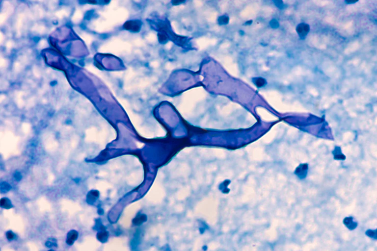 Mucormycosis.