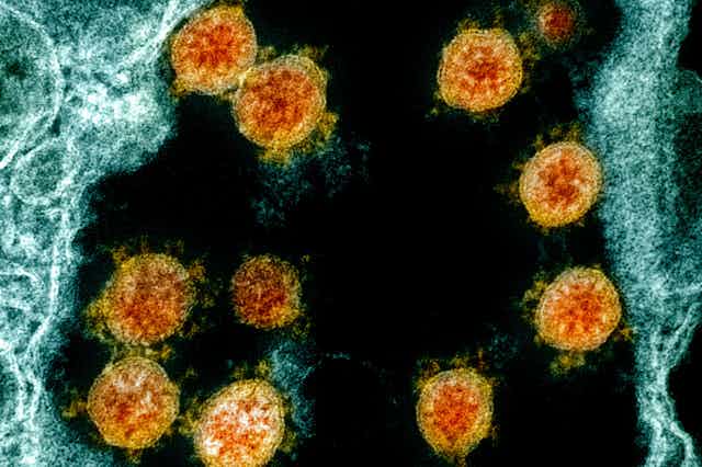 The SARS-CoV-2 coronavirus under an electron microscope