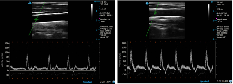 Black and white ultrasound images showing blood flow.