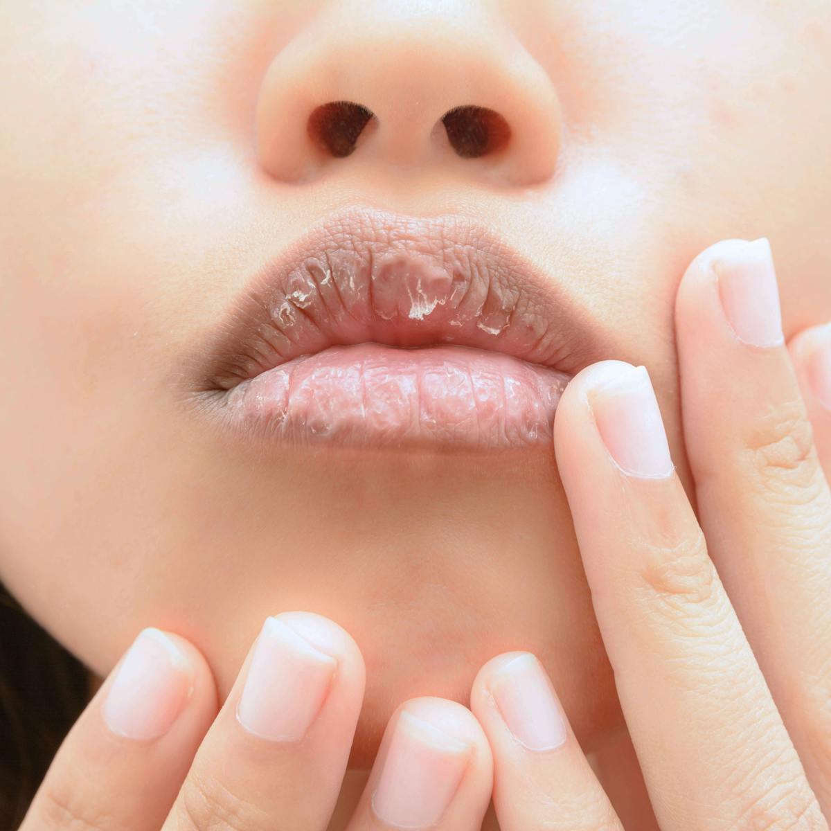 What Causes Dry Lips, And How Can You Treat Them? Does Lip Balm Actually  Help?