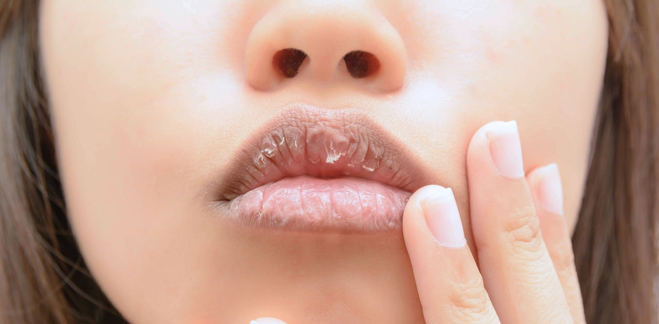 What causes dry lips, and how can you treat them? Does lip balm actually help?