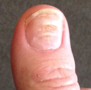 Covid Nails These Changes To Your Fingernails May Show You Ve Had Coronavirus Covid Nails These Changes To Your Fingernails May Show You Ve Had Coronavirus