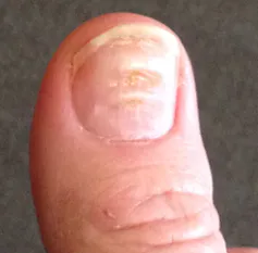 A thumb with Beau's lines