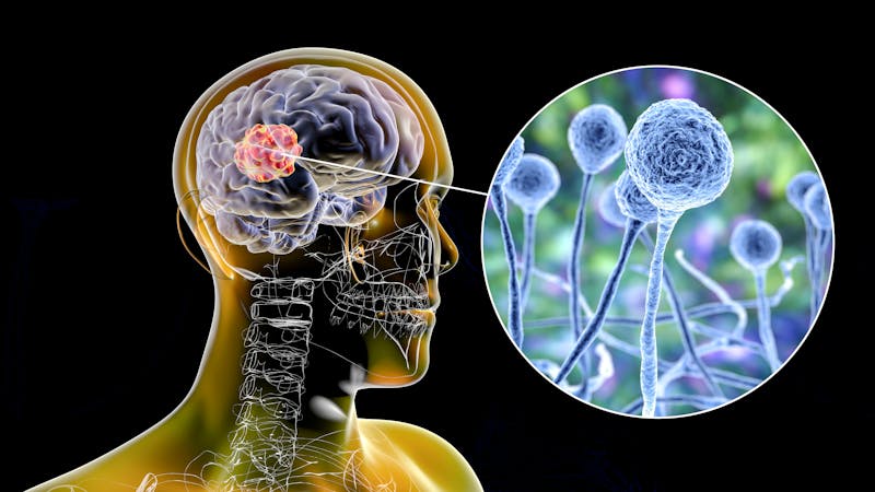 Mucormicosis: ¿por qué afecta a los pacientes de coronavirus? Mucormicosis: ¿por qué afecta a los pacientes de coronavirus?