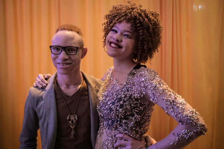 Mr Albinism Kenya Jairus Ongetta (L) and Miss Albinism Kenya Loise Lihanda pose at the Mr and Miss Albinism East Africa pageant.