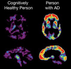 PET scan mostrando o cérebro de uma pessoa cognitivamente saudável e uma pessoa com doença de Alzheimer.