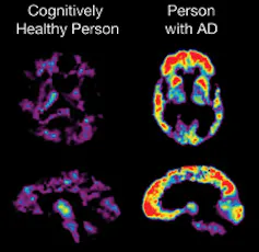PET scan showing the brain of a cognitively healthy person and person with Alzheimer's disease.