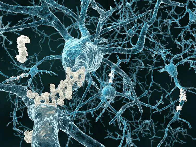 Image en 3D de neurones présentant des plaques amyloïdes