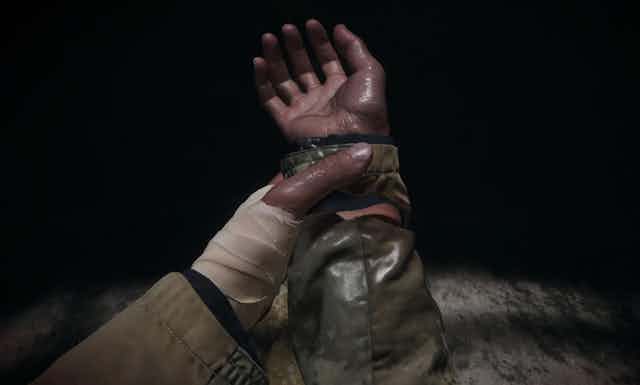 A bandaged hand grips the other hand.