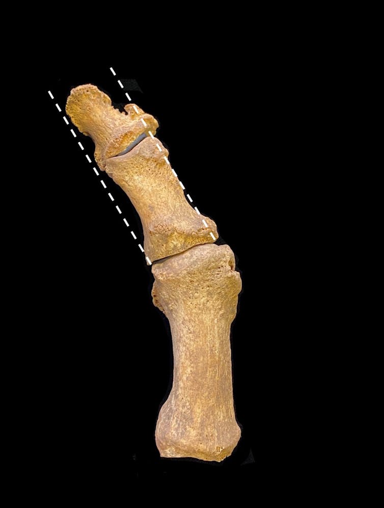 A toe bent toe bone