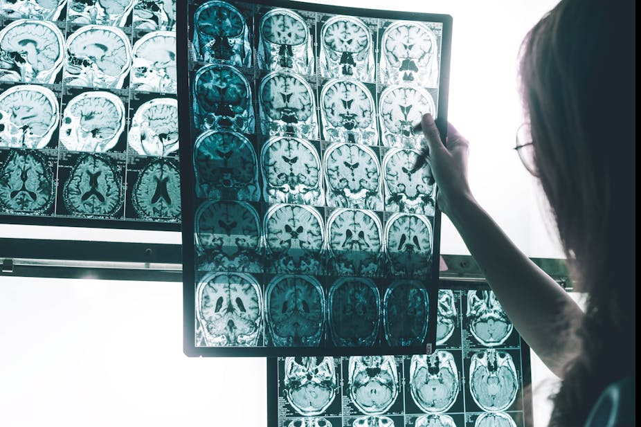 More research is needed to prove the drug slows cognitive decline. New Alzheimer’s drug aducanumab: what we know so far – and why more research is still needed, Aducanumab, Harbouchanews