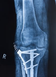 An X-ray of a knee shows elaborate hardware including four long screws in the lower bone and a series of staples near the hardware