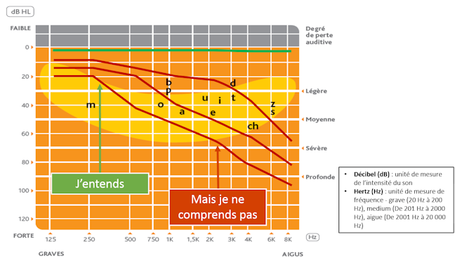 Localisation des phonèmes de la parole sur les courbes de pertes auditives © André Chays/CHU Reims (via The Conversation)
