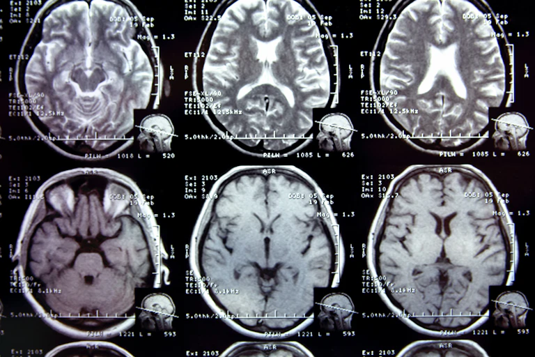 MRI brain scans