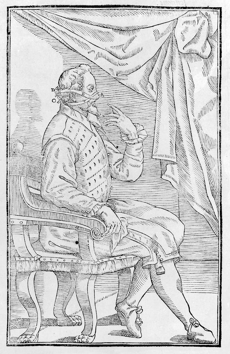 Illustration of 16th-century plastic surgery on the nose.