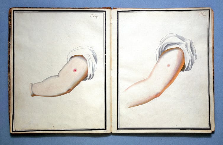 Drawings showing smallpox and cowpox inoculation.