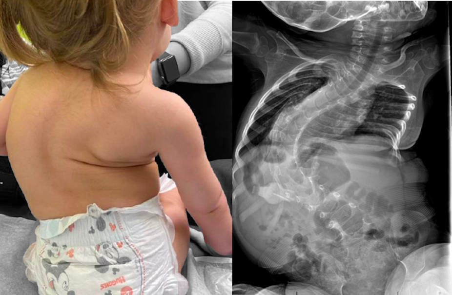 Composite image showing X-ray and child with curvature of the spine caused by muscula atrophy.