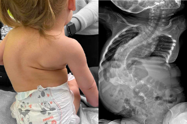 Composite image showing X-ray and child with curvature of the spine caused by muscula atrophy.