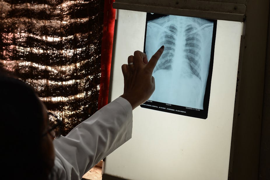Person wearing white coat points to a chest x-ray