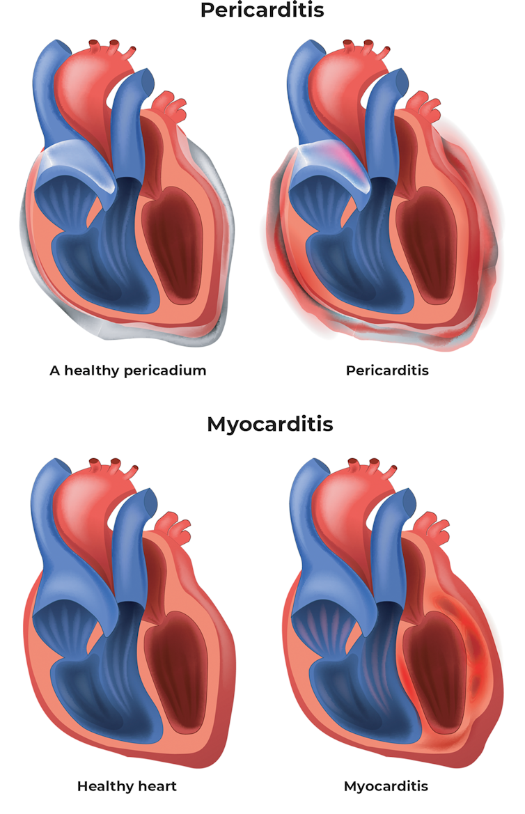 Myocarditis covid vaccine