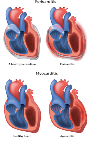 Myocarditis meaning