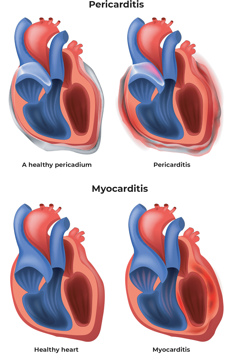 The benefits of a COVID vaccine far outweigh the small risk of treatable heart inflammation