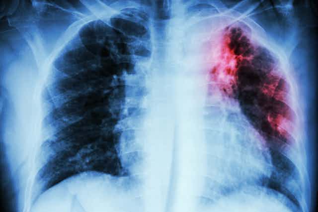 Un pulmón infectado por tuberculosis.