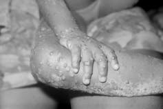 Un niño con erupciones en las manos y las piernas.