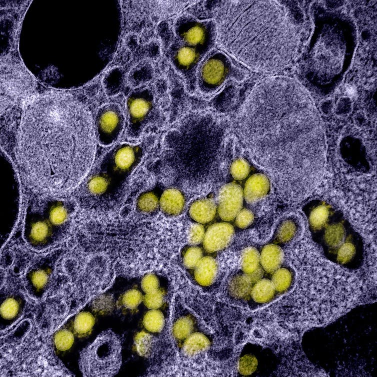 Le virus du Covid est visible par microscopie électronique dans les tissus