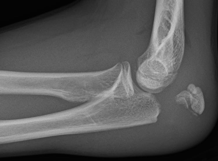 An X-ray image showing a fractured elbow.