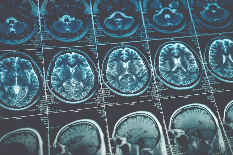 MRI brain scan image.