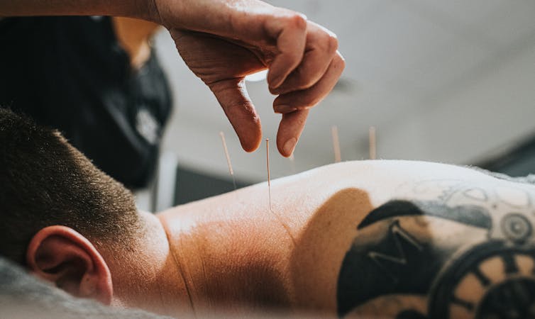 Health care provider performing acupuncture on a person's back.