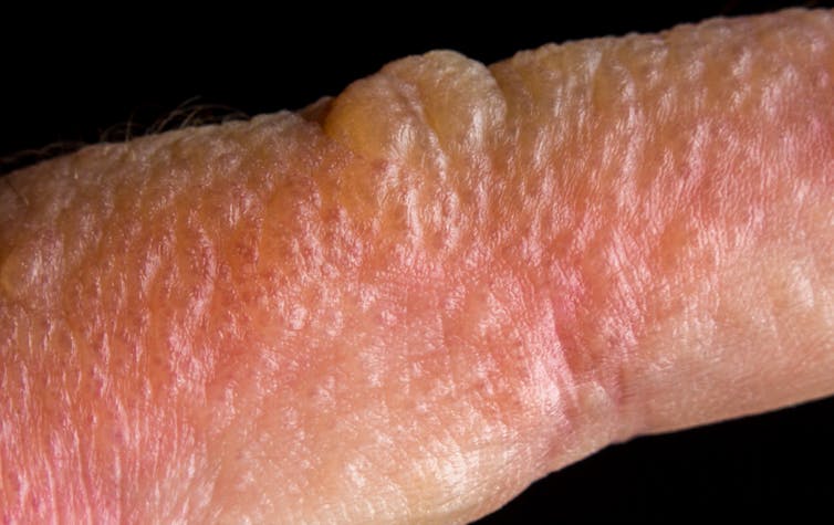 pink rash with blisters on skin close up