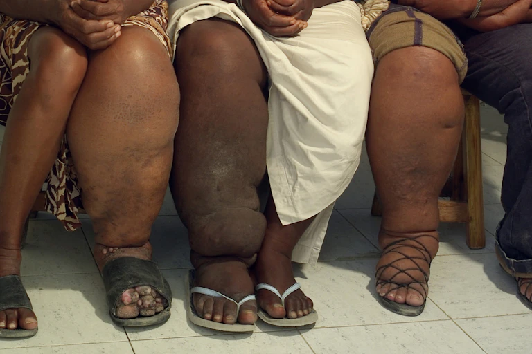 Three women with elephantiasis