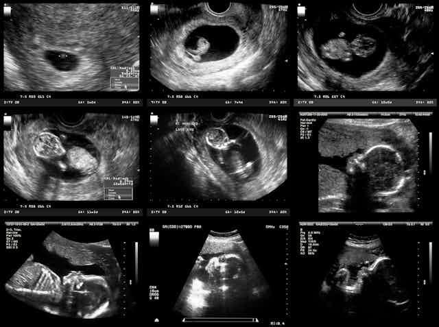 A series of ultrasound images showing several phases of fetal development.