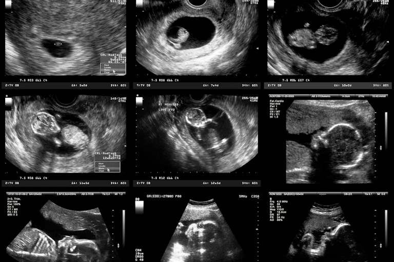A series of ultrasound images showing several phases of fetal development.