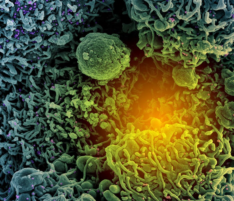 Micrographie électronique du variant alpha du coronavirus infectant une cellule.