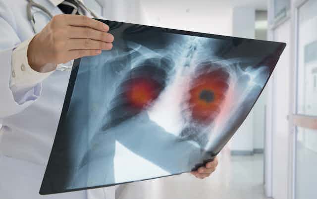 Médico mirando una radiografía de un paciente con cáncer de pulmón.