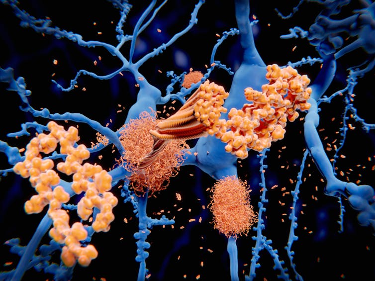 Beta-amyloid plaques (orange) clumping around brain cells (blue).