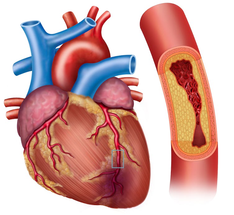 Coronary arteries clogged with plaque.